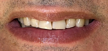 Tratamento com Alinhadores Invisalign, Clareamento e Facetas em Resina antes