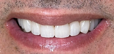 Tratamento com Alinhadores Invisalign, Clareamento e Facetas em Resina depois