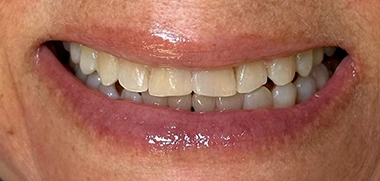 Tratamento com Invisalign não tem limite de idade antes