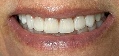 Tratamento com Invisalign não tem limite de idade depois